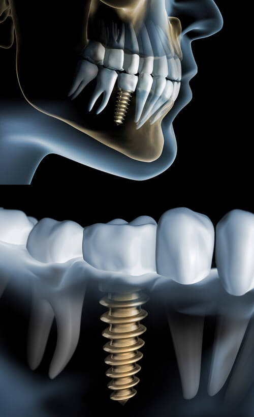 Dental Implants Example