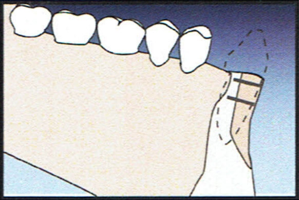 Bone Graft Diagram 1