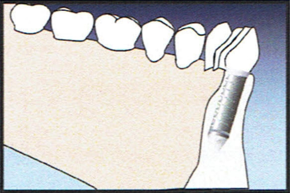 Bone Graft Diagram 2