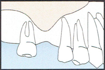 Sinus Graft Diagram 1