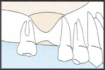 Sinus Graft Diagram 2