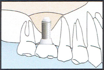 Bone Graft Diagram 3