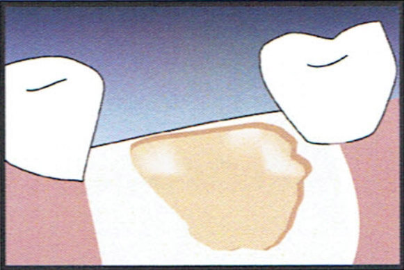 Socket Graft Diagram 1