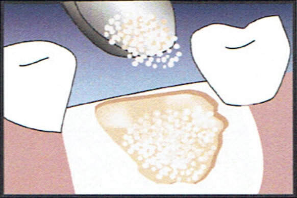 Socket Graft Diagram 2