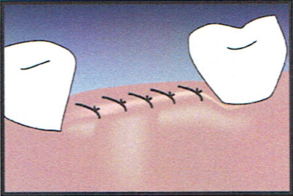 Socket Graft Diagram 3